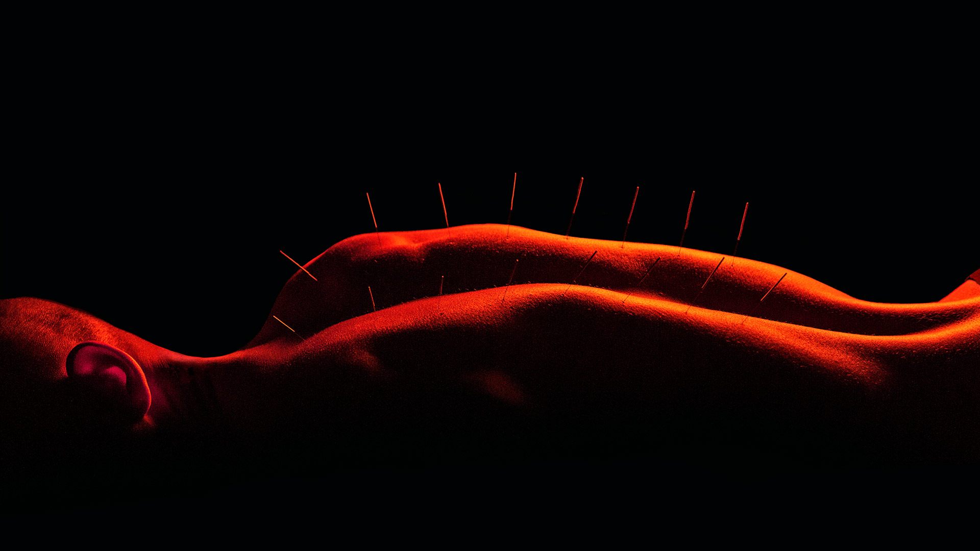a person laying on their stomach receiving acupuncture.